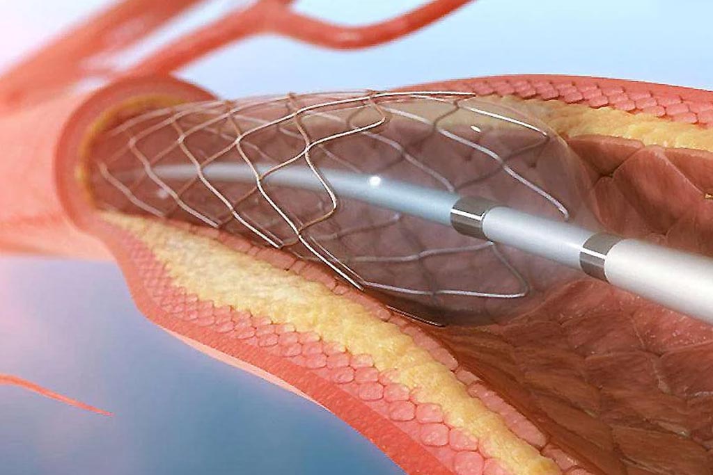 Peripheral Artery Surgery